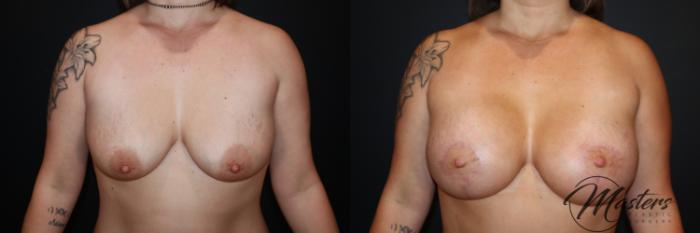 Breast Augmentation With Mastopexy 