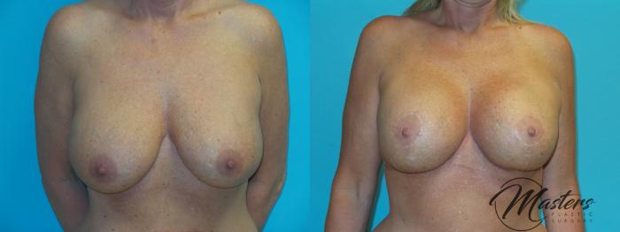 Before & After Breast Augmentation with Lift Case 21 Front View in Oklahoma City, Tulsa, Norman, OK
