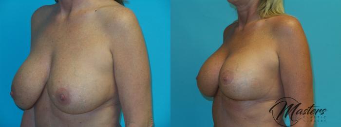 Before & After Breast Augmentation with Lift Case 21 Left Oblique View in Oklahoma City, Tulsa, Norman, OK