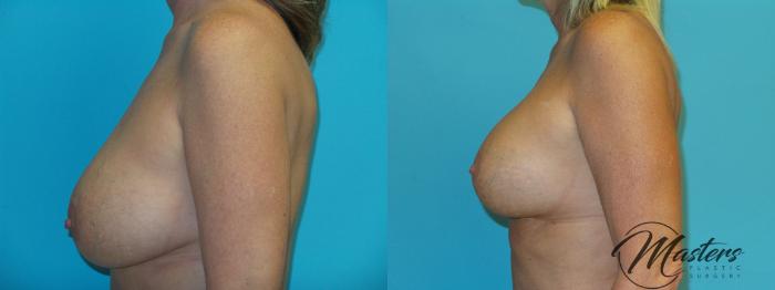 Before & After Breast Augmentation with Lift Case 21 Left Side View in Oklahoma City, Tulsa, Norman, OK