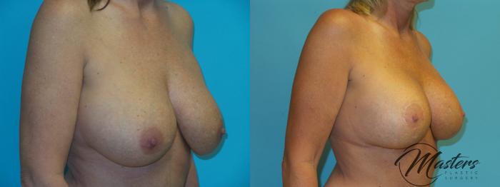 Before & After Breast Augmentation with Lift Case 21 Right Oblique View in Oklahoma City, Tulsa, Norman, OK