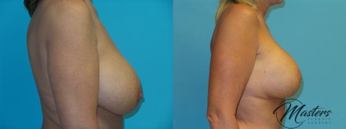 Before & After Breast Augmentation with Lift Case 21 Right Side View in Oklahoma City, Tulsa, Norman, OK