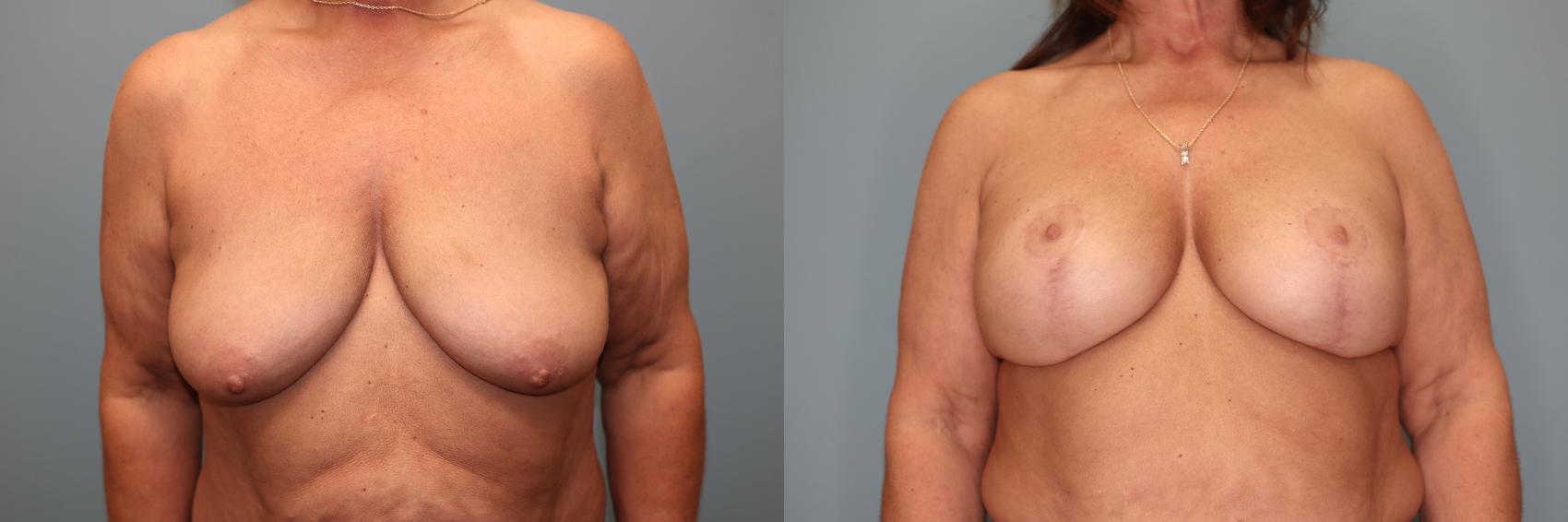 Before & After Breast Augmentation with Lift Case 36 Front View in Oklahoma City, Tulsa, Norman, OK