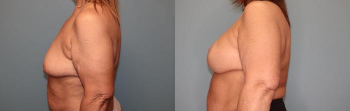 Before & After Breast Augmentation with Lift Case 36 Left Side View in Oklahoma City, Tulsa, Norman, OK