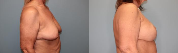 Before & After Breast Augmentation with Lift Case 36 Right Side View in Oklahoma City, Tulsa, Norman, OK
