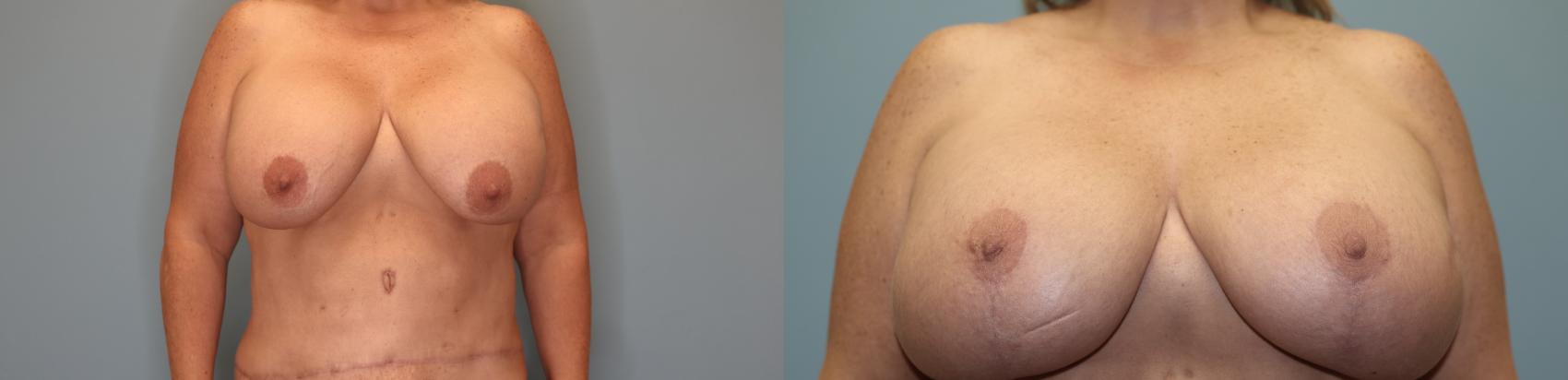 Before & After Breast Augmentation with Lift Case 37 Front View in Oklahoma City, Tulsa, Norman, OK