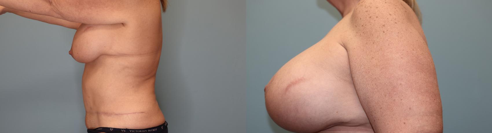 Before & After Breast Augmentation with Lift Case 37 Left Side View in Oklahoma City, Tulsa, Norman, OK