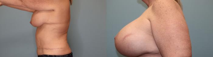 Before & After Breast Augmentation with Lift Case 37 Left Side View in Oklahoma City, Tulsa, Norman, OK