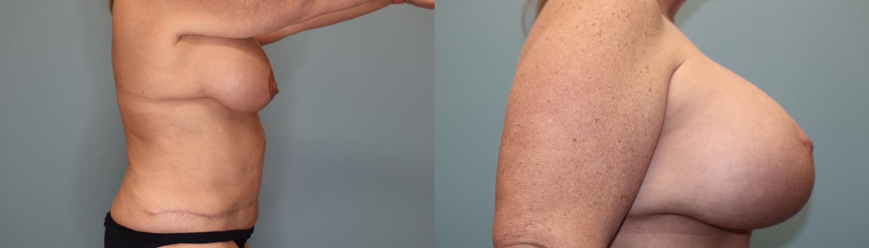 Before & After Breast Augmentation with Lift Case 37 Right Side View in Oklahoma City, Tulsa, Norman, OK