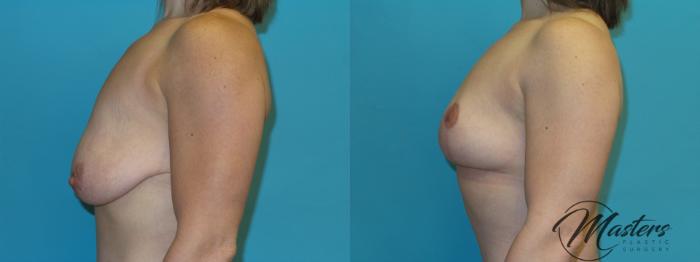 Before & After Breast Augmentation with Lift Case 7 Left Side View in Oklahoma City, Tulsa, Norman, OK