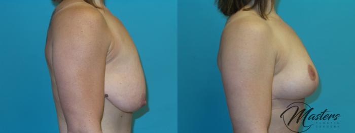 Before & After Breast Augmentation with Lift Case 7 Right Side View in Oklahoma City, Tulsa, Norman, OK