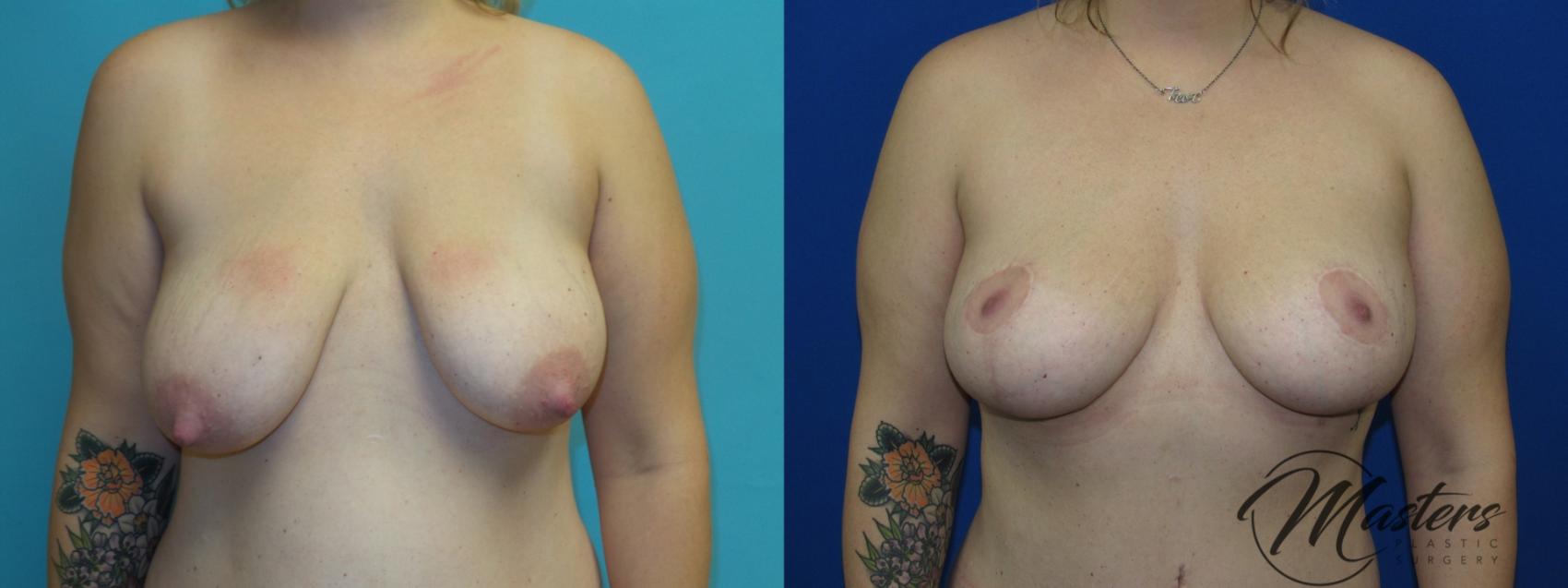 Before & After Breast Augmentation with Lift Case 8 Front View in Oklahoma City, Tulsa, Norman, OK