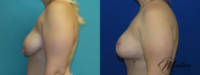 Before & After Breast Augmentation with Lift Case 8 Left Side View in Oklahoma City, Tulsa, Norman, OK