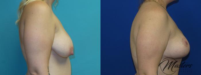 Before & After Breast Augmentation with Lift Case 8 Right Side View in Oklahoma City, Tulsa, Norman, OK