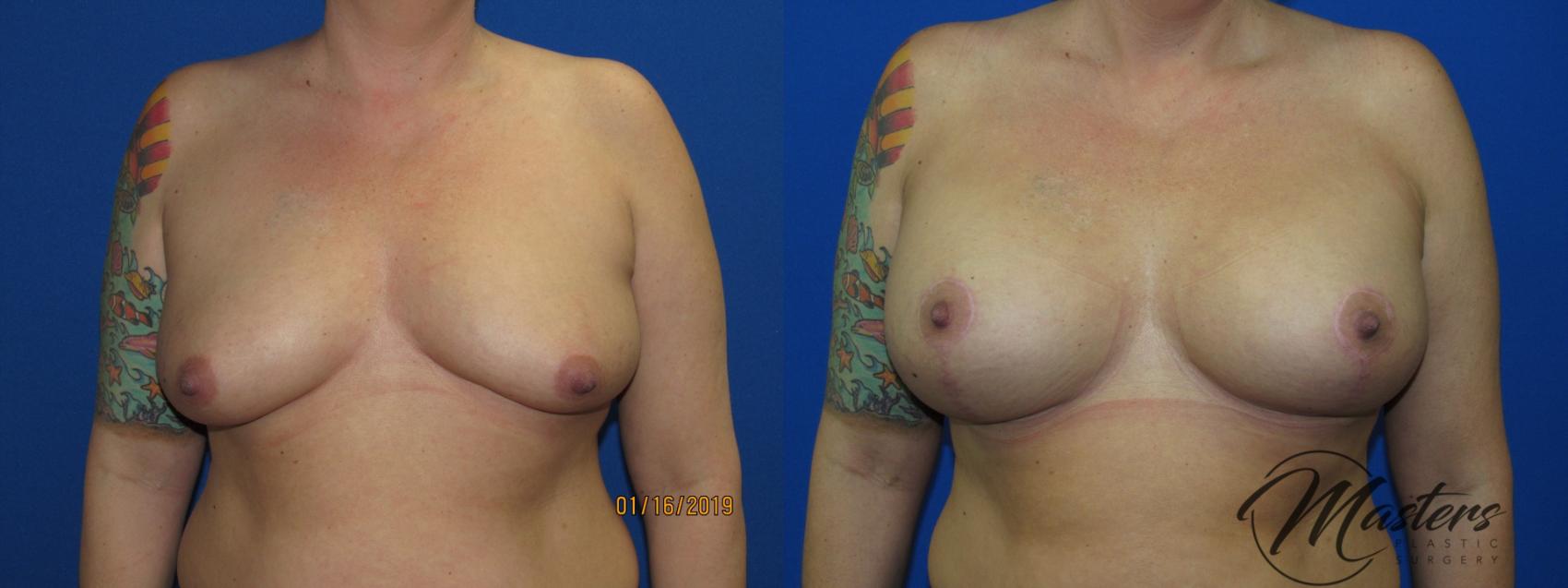 Before & After Breast Augmentation with Lift Case 9 Front View in Oklahoma City, Tulsa, Norman, OK