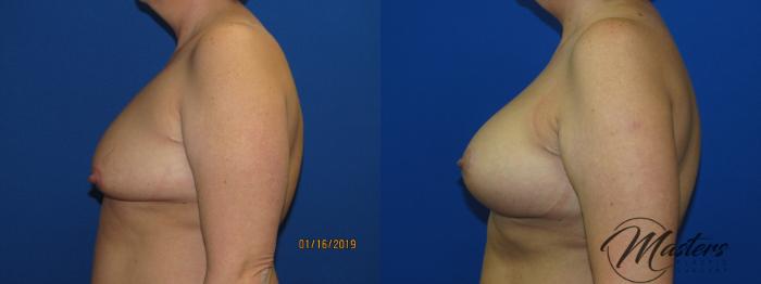 Before & After Breast Augmentation with Lift Case 9 Left Side View in Oklahoma City, Tulsa, Norman, OK