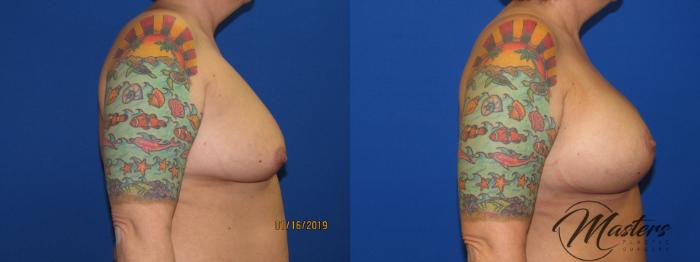 Before & After Breast Augmentation with Lift Case 9 Right Side View in Oklahoma City, Tulsa, Norman, OK