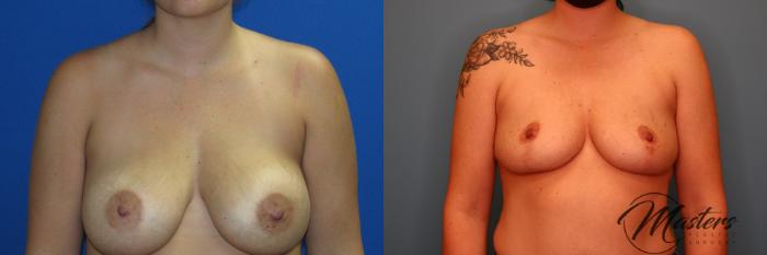 Before & After Breast Implant Removal with Lift Case 10 Front View in Oklahoma City, Tulsa, Norman, OK