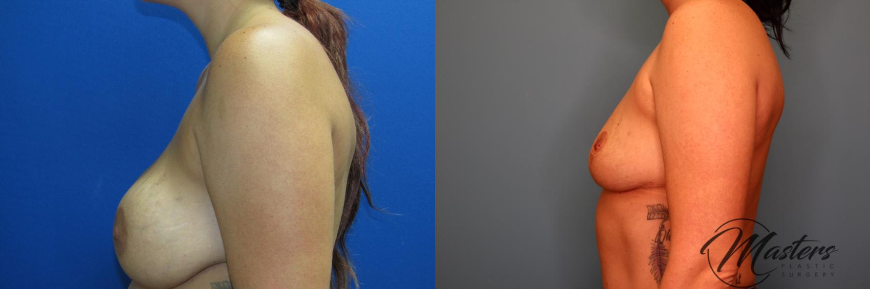Before & After Breast Implant Removal with Lift Case 10 Left Side View in Oklahoma City, Tulsa, Norman, OK