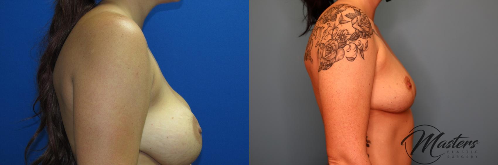 Before & After Breast Implant Removal with Lift Case 10 Right Side View in Oklahoma City, Tulsa, Norman, OK
