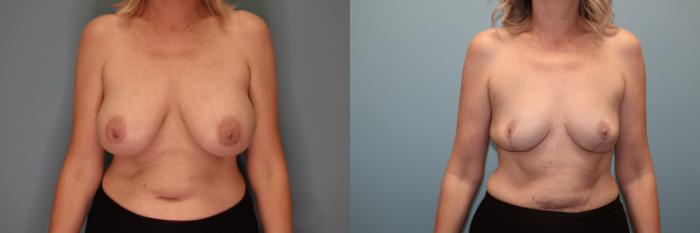 Before & After Breast Implant Removal with Lift Case 51 Front View in Oklahoma City, Tulsa, Norman, OK