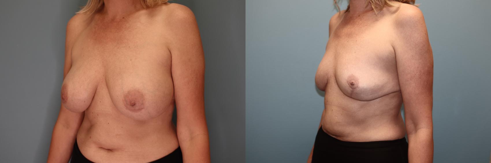 Before & After Breast Implant Removal with Lift Case 51 Left Oblique View in Oklahoma City, Tulsa, Norman, OK