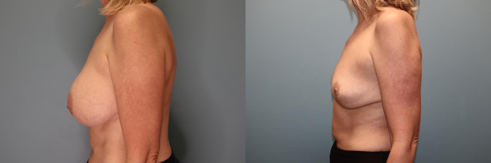 Before & After Breast Implant Removal with Lift Case 51 Left Side View in Oklahoma City, Tulsa, Norman, OK