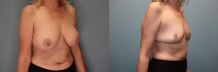 Before & After Breast Implant Removal with Lift Case 51 Right Oblique View in Oklahoma City, Tulsa, Norman, OK