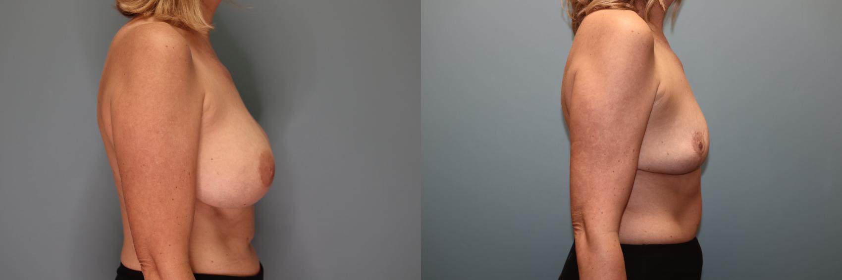 Before & After Breast Implant Removal with Lift Case 51 Right Side View in Oklahoma City, Tulsa, Norman, OK