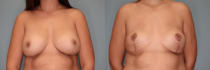 Before & After Breast Implant Removal with Lift Case 53 Front View in Oklahoma City, Tulsa, Norman, OK