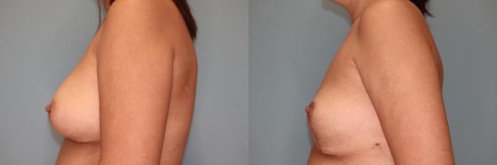 Before & After Breast Implant Removal with Lift Case 53 Left Side View in Oklahoma City, Tulsa, Norman, OK