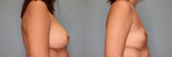 Before & After Breast Implant Removal with Lift Case 53 Right Side View in Oklahoma City, Tulsa, Norman, OK
