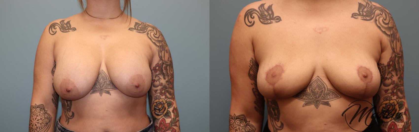 Before & After Breast Implant Removal with Lift Case 54 Front View in Oklahoma City, Tulsa, Norman, OK