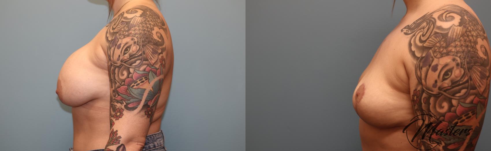Before & After Breast Implant Removal with Lift Case 54 Left Side View in Oklahoma City, Tulsa, Norman, OK
