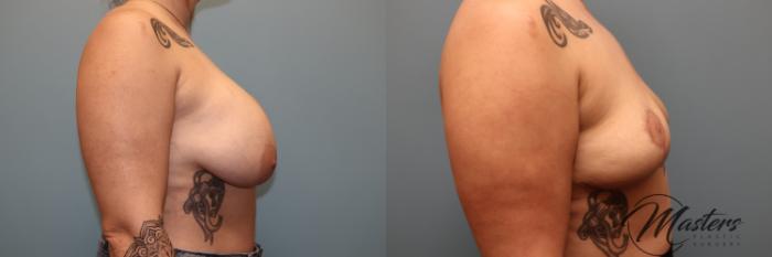 Before & After Breast Implant Removal with Lift Case 54 Right Side View in Oklahoma City, Tulsa, Norman, OK