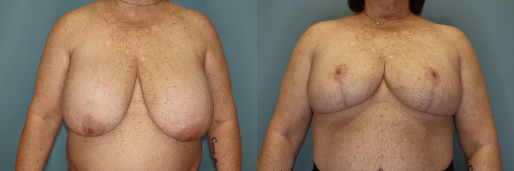 Before & After Breast Implant Removal with Lift Case 56 Front View in Oklahoma City, Tulsa, Norman, OK