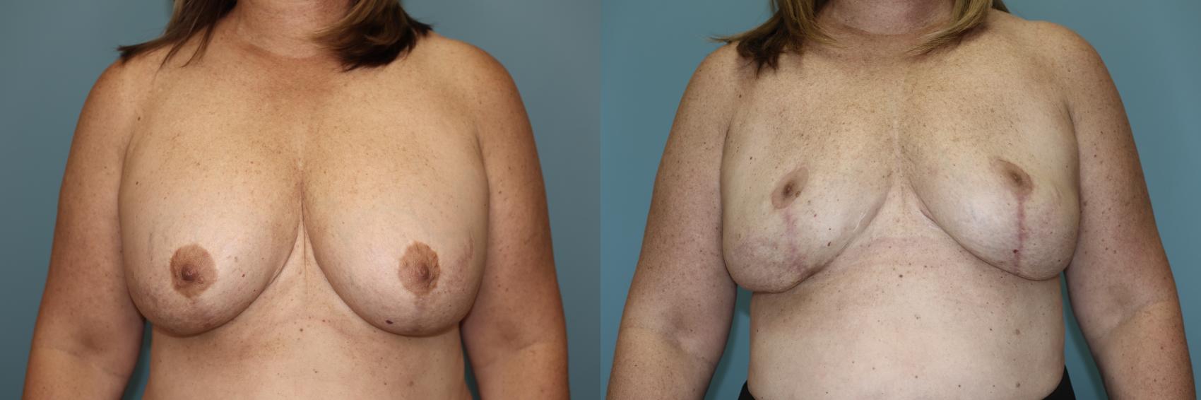 Before & After Breast Implant Removal with Lift Case 59 Front View in Oklahoma City, Tulsa, Norman, OK