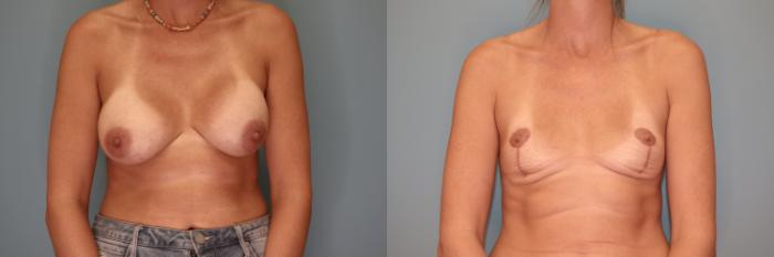 Before & After Breast Implant Removal with Lift Case 61 Front View in Oklahoma City, Tulsa, Norman, OK