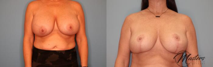 Before & After Breast Implant Removal with Lift Case 63 Front View in Oklahoma City, Tulsa, Norman, OK