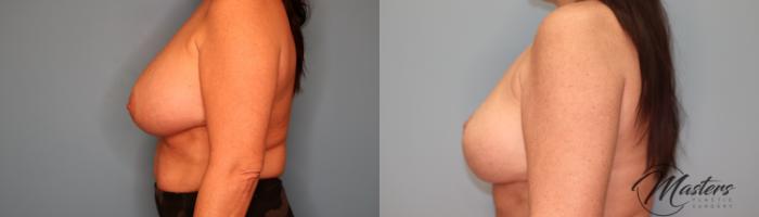 Before & After Breast Implant Removal with Lift Case 63 Left Side View in Oklahoma City, Tulsa, Norman, OK