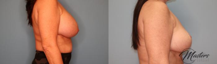 Before & After Breast Implant Removal with Lift Case 63 Right Side View in Oklahoma City, Tulsa, Norman, OK