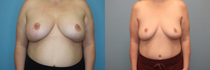 Before & After Breast Implant Removal with no Lift Case 40 Front View in Oklahoma City, Tulsa, Norman, OK