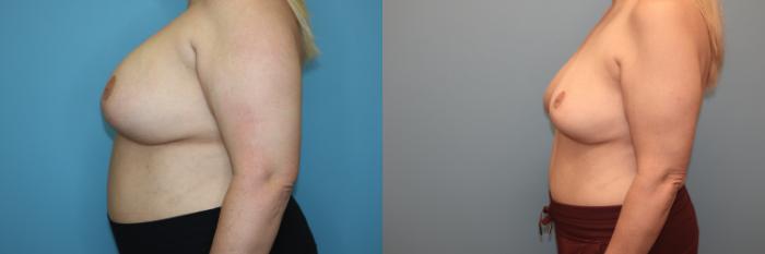 Before & After Breast Implant Removal with no Lift Case 40 Left Side View in Oklahoma City, Tulsa, Norman, OK