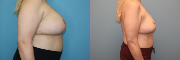 Before & After Breast Implant Removal with no Lift Case 40 Right Side View in Oklahoma City, Tulsa, Norman, OK