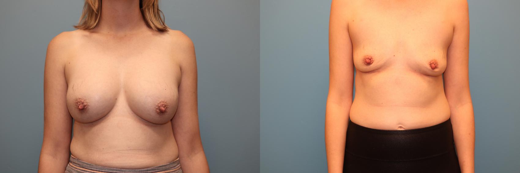Before & After Breast Implant Removal with no Lift Case 41 Front View in Oklahoma City, Tulsa, Norman, OK