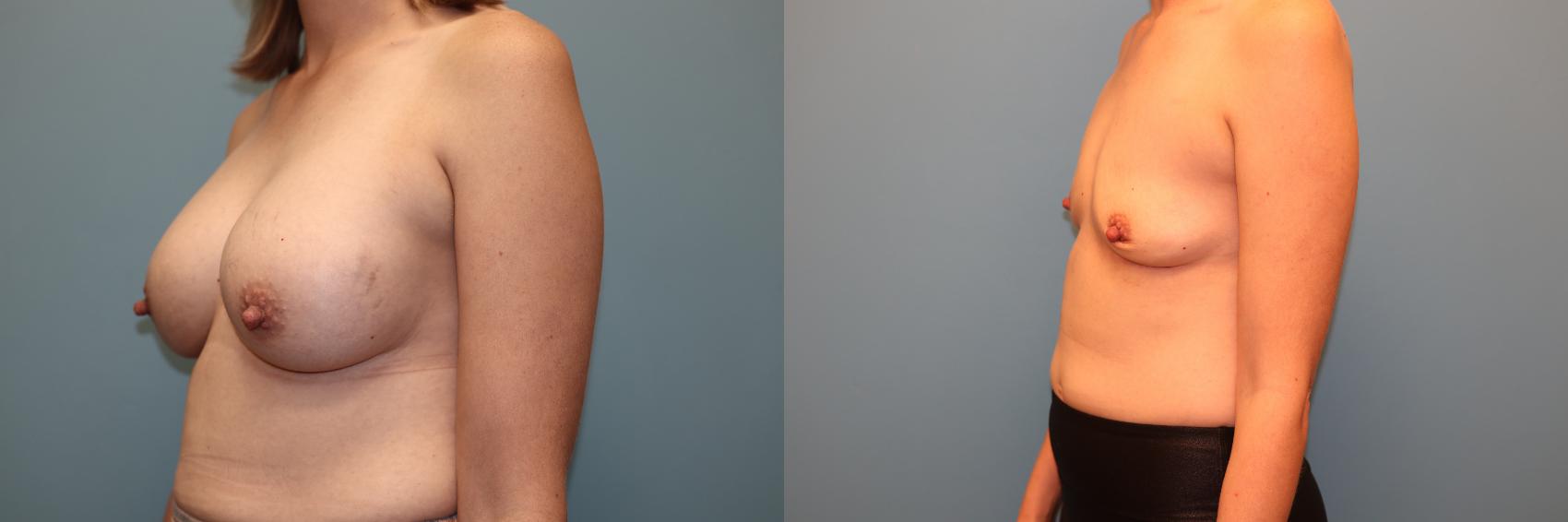 Before & After Breast Implant Removal with no Lift Case 41 Left Oblique View in Oklahoma City, Tulsa, Norman, OK
