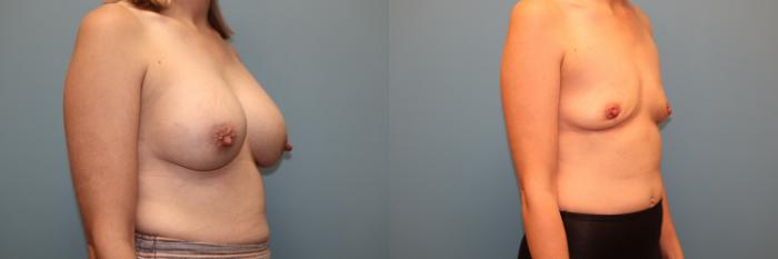 Before & After Breast Implant Removal with no Lift Case 41 Right Oblique View in Oklahoma City, Tulsa, Norman, OK
