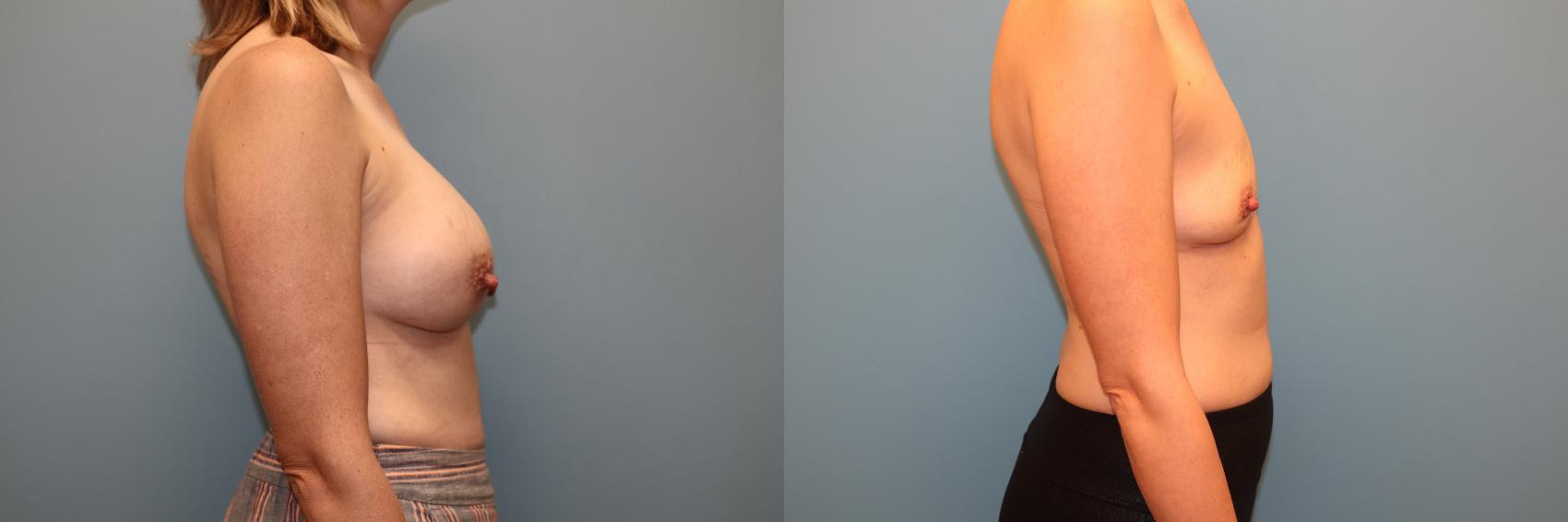 Before & After Breast Implant Removal with no Lift Case 41 Right Side View in Oklahoma City, Tulsa, Norman, OK