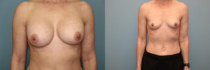 Before & After Breast Implant Removal with no Lift Case 42 Front View in Oklahoma City, Tulsa, Norman, OK