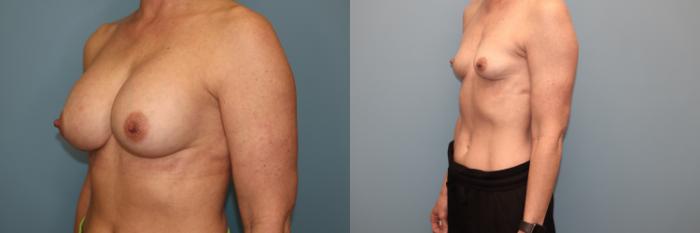 Before & After Breast Implant Removal with no Lift Case 42 Left Oblique View in Oklahoma City, Tulsa, Norman, OK